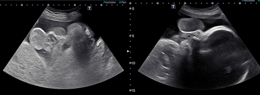 Sonographic imaging of epulis