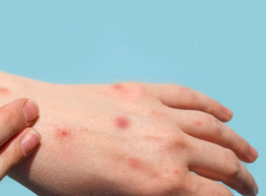 child's hand with mpox