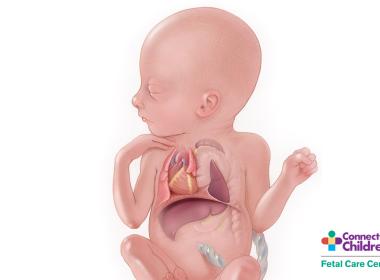 Medical illustration of congenital diaphragmatic hernia