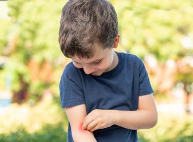 Young boy itching mosquito bite on arm.