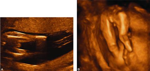 An ultrasound