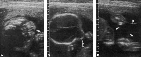 An ultrasound