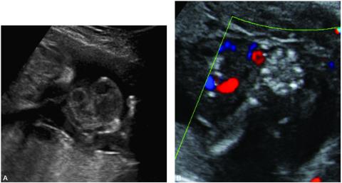 An ultrasound