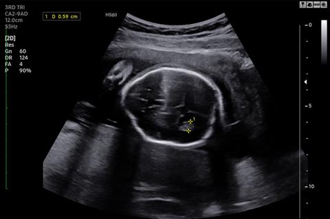 An ultrasound