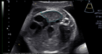 An ultrasound 