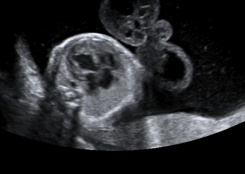 An ultrasound