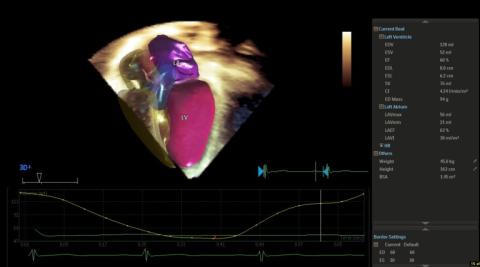 Imaging from the Echocardiography Lab at Connecticut Children's