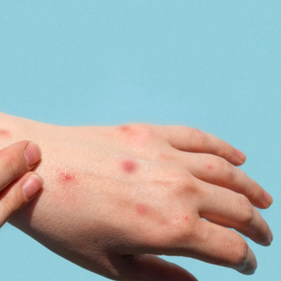 child's hand with mpox